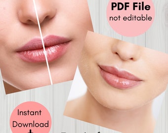 Nasolabial Folds Mapping Training, Hyaluron Pen Nasolabial Fold