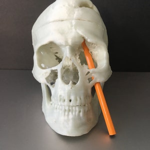 Phineas Gage Skull