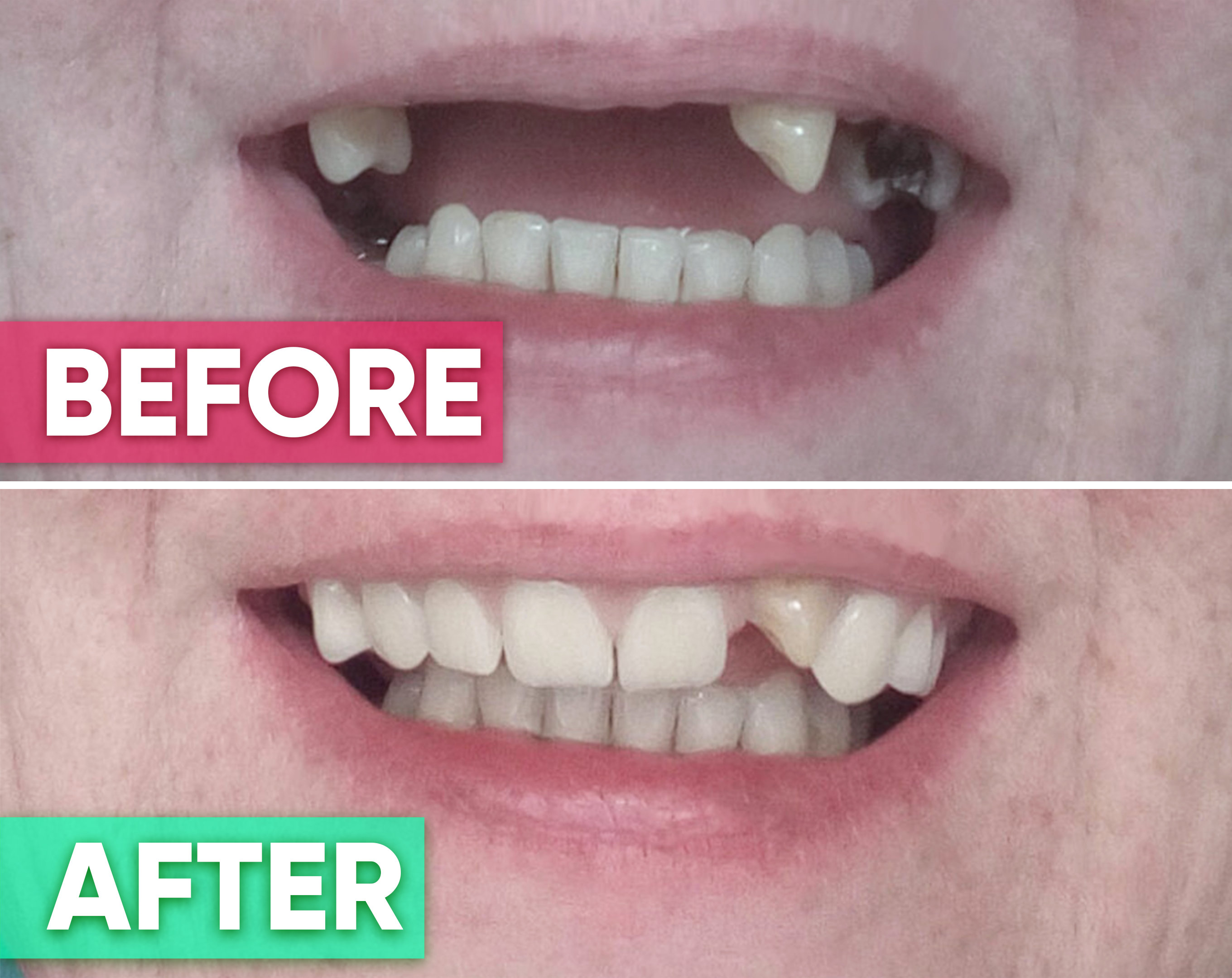 Single Tooth Denture Cost South Africa edu.svet.gob.gt