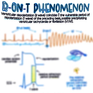 Puede incluir: Un diagrama que ilustra el fenómeno R-on-T en cardiología. El diagrama muestra un trazado de electrocardiograma (ECG) con una línea azul que representa la onda R y una línea marrón que representa la onda T. El texto explica que la despolarización ventricular (onda R) coincide con el período vulnerable de la repolarización (onda T) del latido precedente, lo que puede provocar taquicardia ventricular o fibrilación (TV/FV).