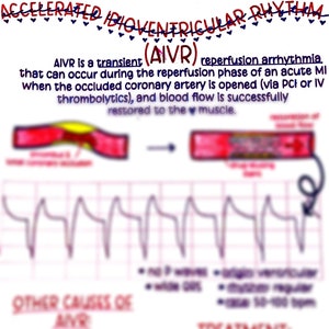 Accelerated Idioventricular Rhythm (AIVR)