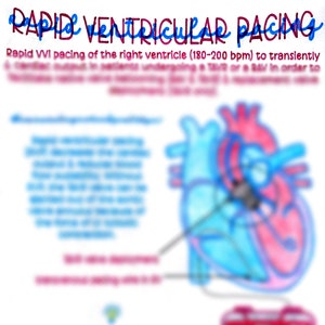 Estimulación ventricular rápida (RVP)