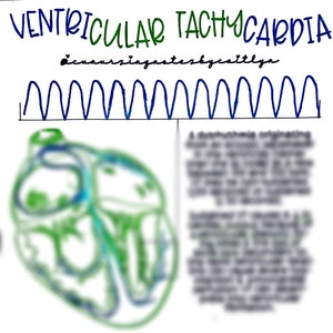 Ventrikuläre Tachykardie (VT)