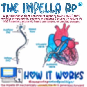 The Impella RP® & Waveforms - Etsy