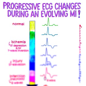 Cambios en el ECG STEMI