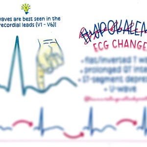 Cambios en el electrocardiograma de hipopotasemia e hiperpotasemia