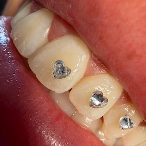Puede incluir: Tres gemas dentales transparentes en forma de corazón están adheridas a la superficie de tres dientes adyacentes. Las gemas están facetadas y reflejan la luz, apareciendo como adornos brillantes y transparentes centrados en el esmalte de cada diente.
