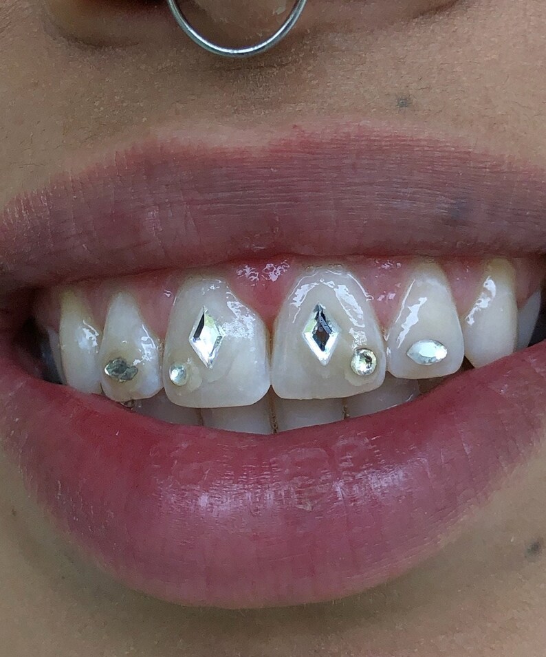 May include: Close-up of a person's smile with several teeth decorated with small, clear, diamond-shaped rhinestones.
