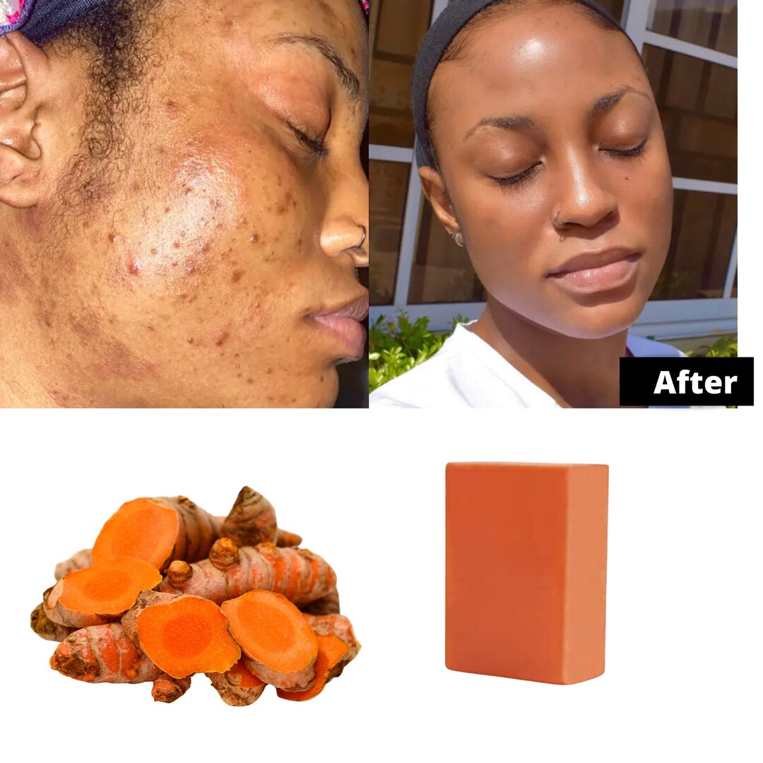 Turmeric Bar Soap Dark Spots Remover Glowing and Radiant Etsy Canada