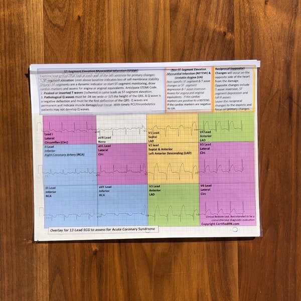 ECG overlay a 12 derivazioni per rilevare STEMI/NSTEMI (2 inclusi)