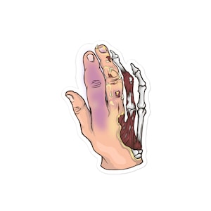May include: A sticker featuring a detailed illustration of a hand with visible bone structure, muscles, and skin. The hand shows a purple bruise and areas of yellow and red, with a white outline.