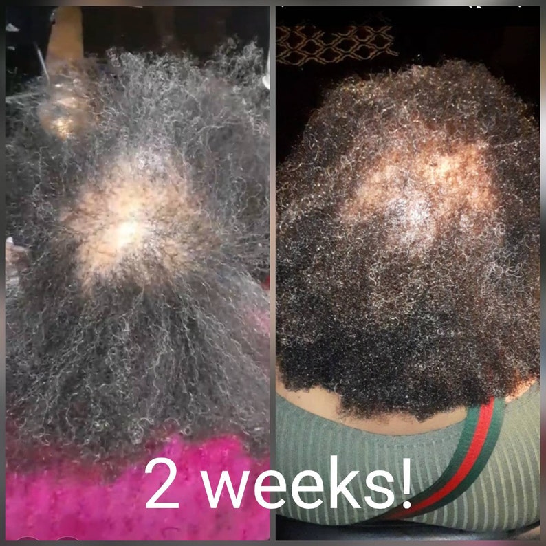 May include: Two images showing the back of a person's head with hair. The first image shows a person with thinning hair. The second image shows the same person with thicker hair. The text "2 weeks!" is written below the images.