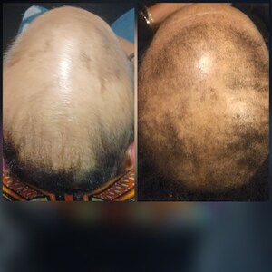 May include: A side-by-side comparison of a person's scalp before and after hair growth treatment. The left side shows a scalp with thinning hair, while the right side shows a scalp with thicker, fuller hair.
