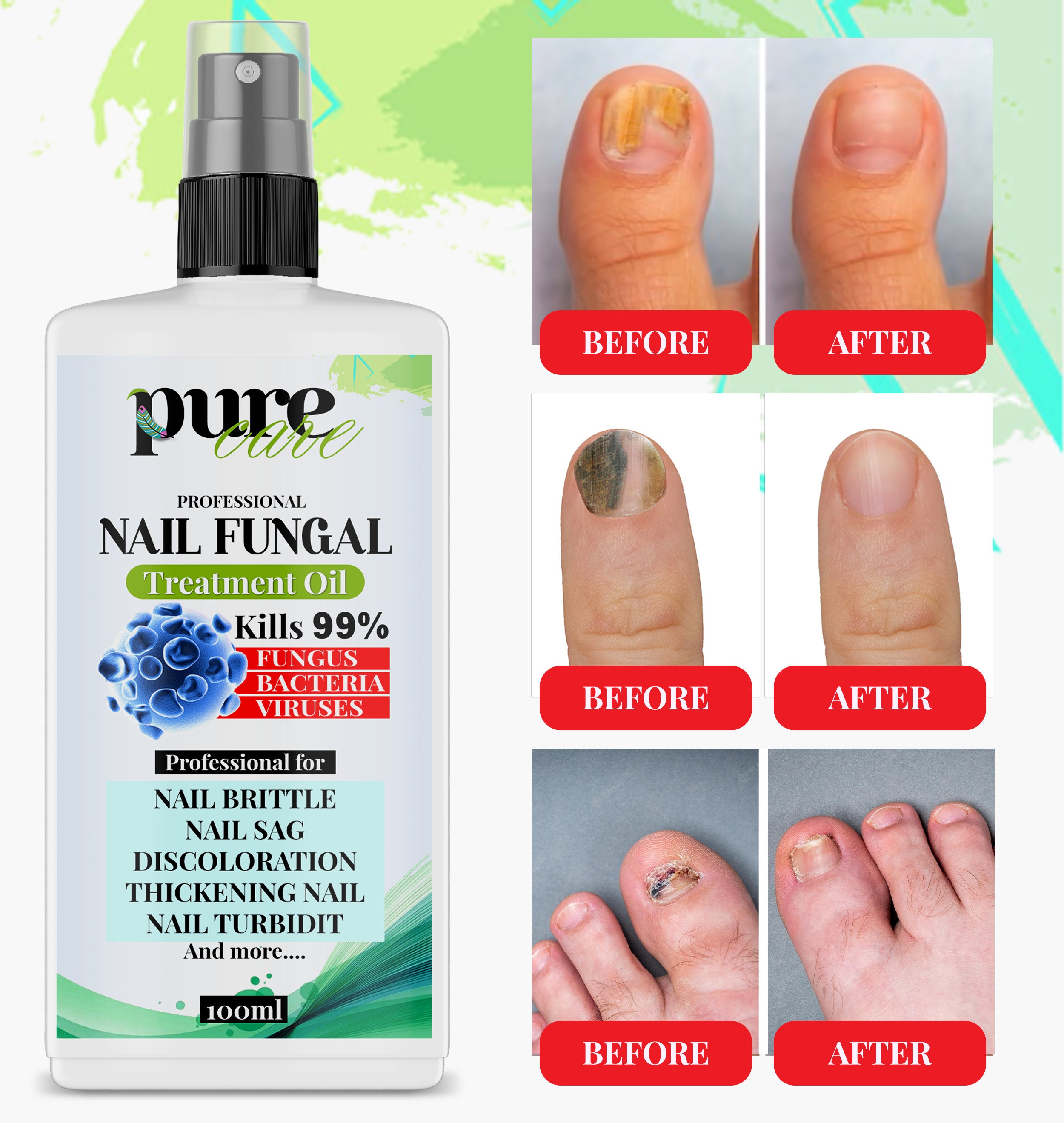 Nail fungus removal treatment 🤩 Is a state-of-the-art solution for treating  fungal nail infections. It utilizes a laser-based technology… | Instagram