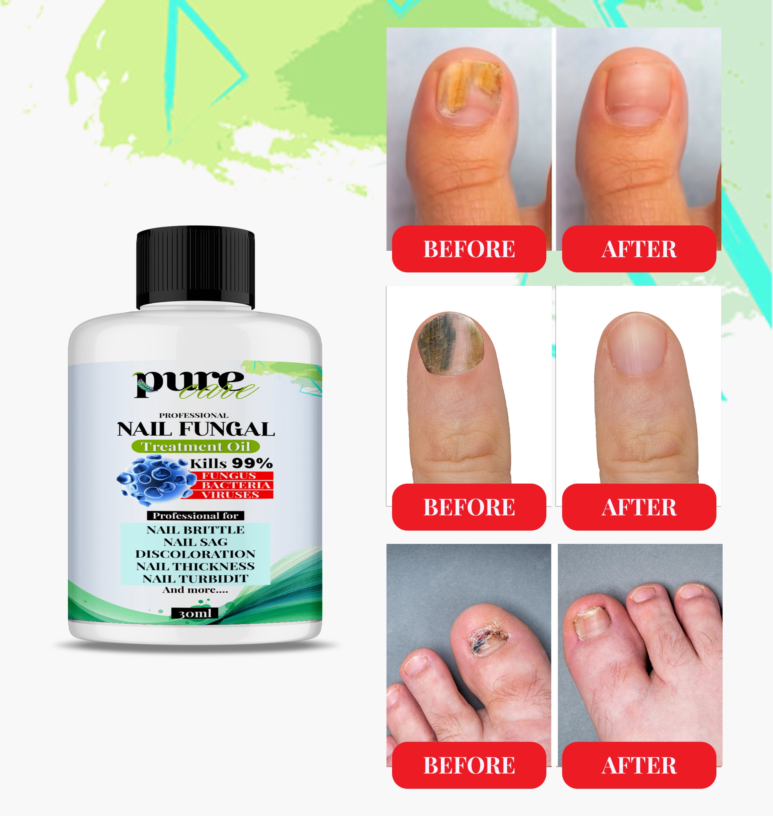 Best Toe Nail Fungus Treatments [Onychomycosis Remedies] - YouTube