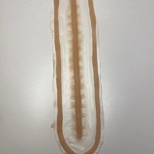 Prosthesis scar stitched up