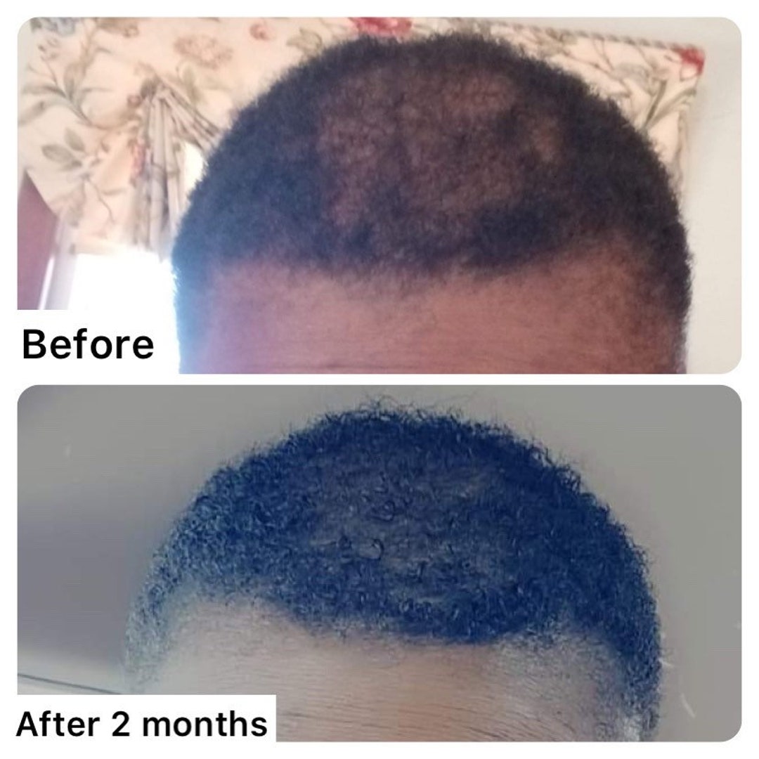 Ashwagandha and Saw Palmetto Herbal Scalp and Hair Oil Etsy