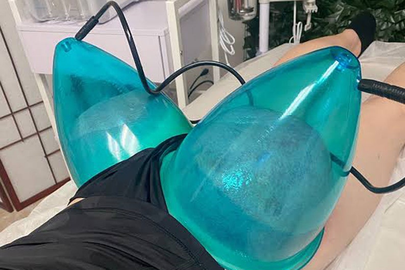 May include: Two blue plastic cups with clear water inside are attached to a person's body with black tubes. The cups are used for a beauty treatment.
