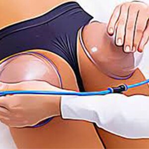 May include: A person receiving a cupping therapy treatment. Two clear suction cups are attached to the person's skin with a blue tube connecting them.