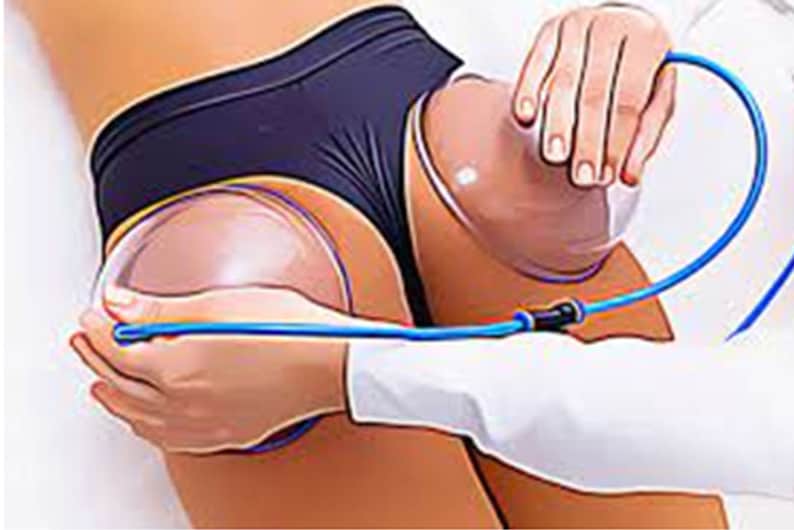 May include: A person receiving a cupping therapy treatment. Two clear suction cups are attached to the person's skin with a blue tube connecting them.