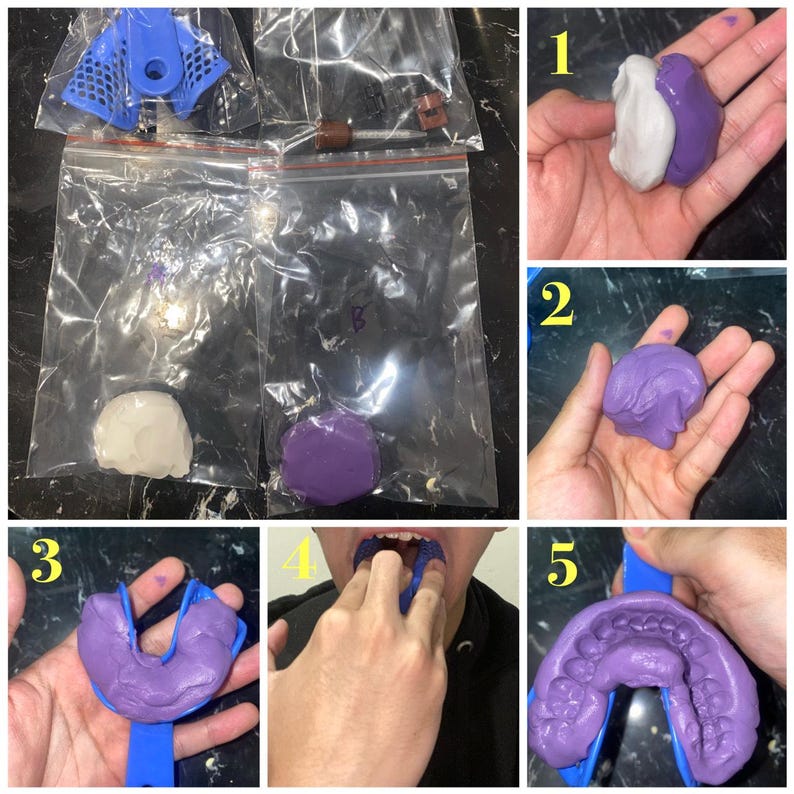 May include: A series of images showing the process of creating a dental impression. The process includes mixing white and purple putty, molding it, and using a blue tray to create a mold of the teeth.