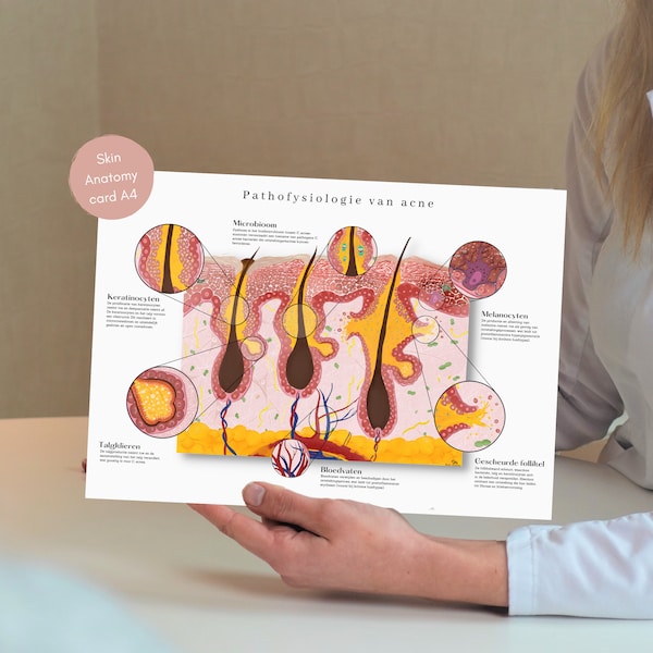 Acne card, Acne poster, Skin anatomy, Skin graphic, Anatomy poster, Skin intruction card, Medische student gift, Dermatoloog, Huidtherapeut