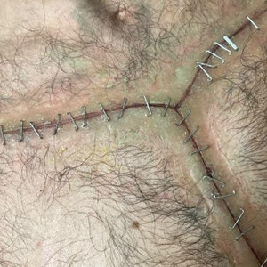 SFX makeup Prosthetic Autopsy scar incision