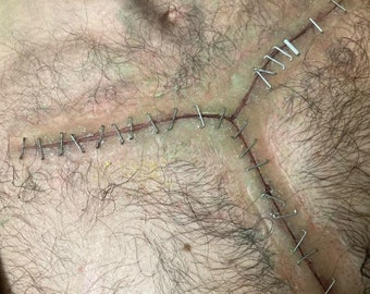 May include: Close-up of a surgical incision on a person's chest, showing staples and stitches.