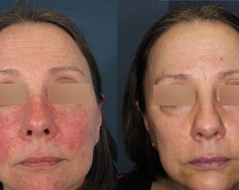 MSM gel for Rosacea, Acne, Dermatitis, Redness, Red acne scars, Scares, help wrinkles collagen Methylsulfonylmethane vegan