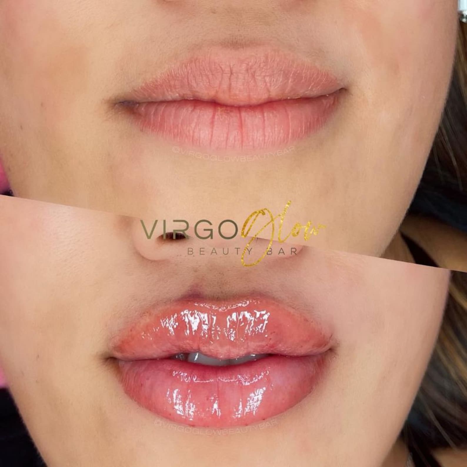 Hyaluron Pen Lip Mapping, Lip Filler Mapping, Russian Lip Technique