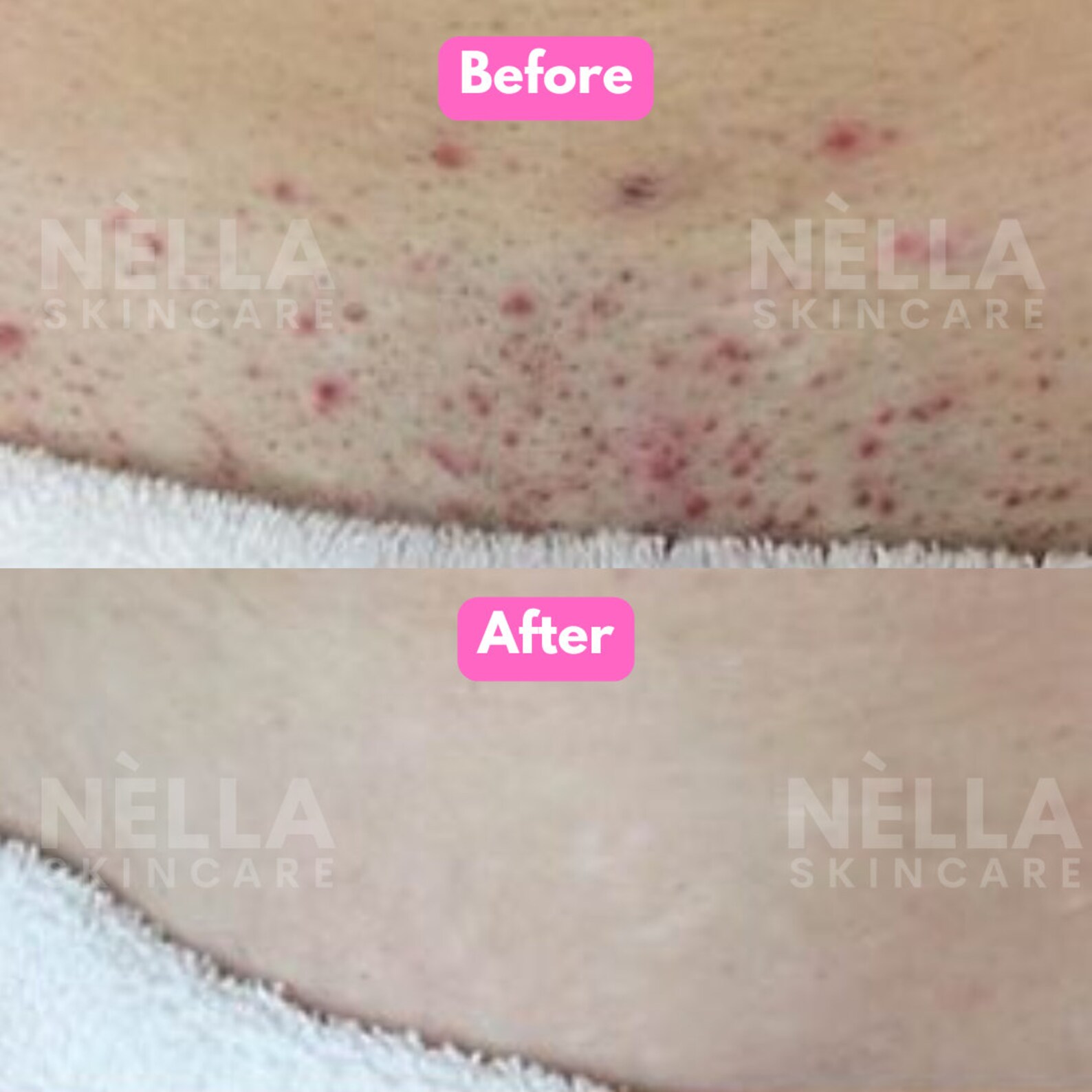 KP Bump Eraser Ingrown Hairs Razor Bumps and Dark Spots Etsy