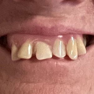Custom Fitted Party Teeth Halloween False Teeth Theatre Teeth Pageant Teeth