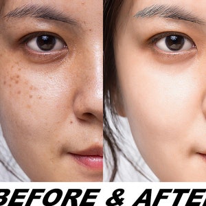 May include: Before and after photo showing the difference in skin tone and texture. The image on the left shows a person with freckles and uneven skin tone. The image on the right shows the same person with a more even skin tone and fewer freckles.