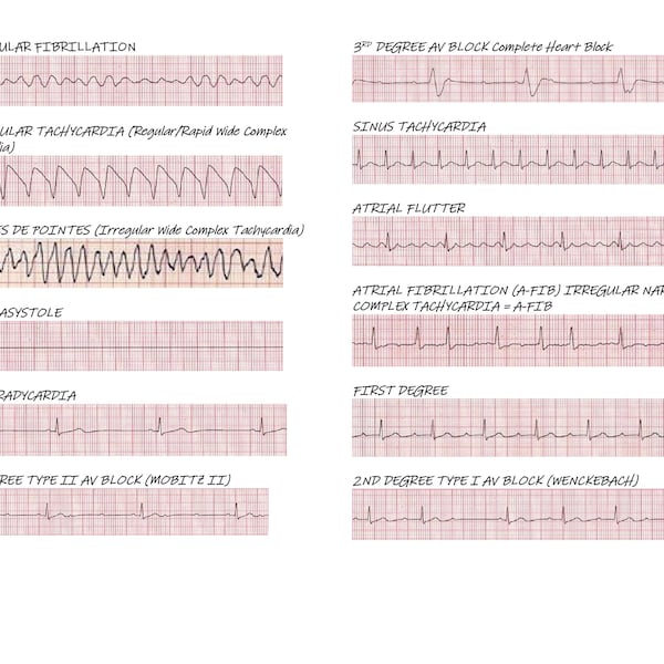 Cardiac Rhythm examples