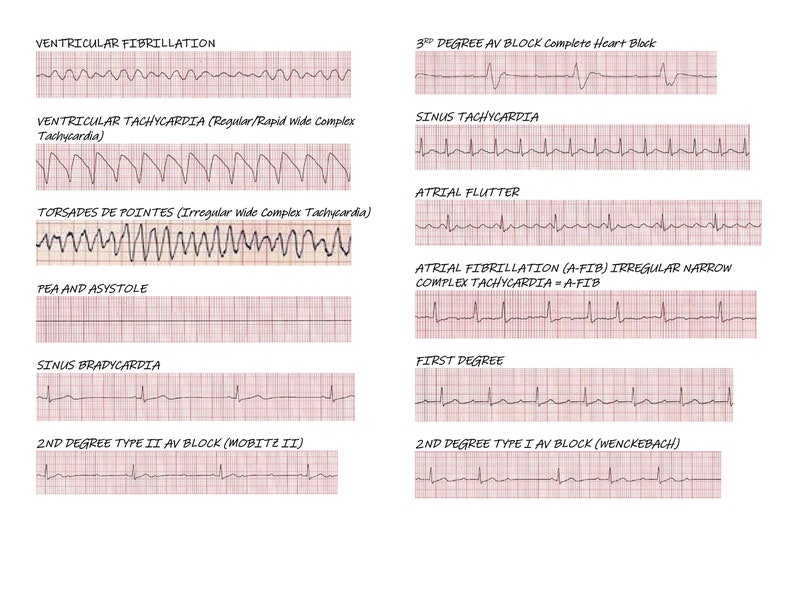 cardiac-rhythm-examples-etsy