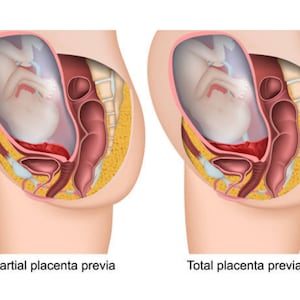 Puede incluir: Dos ilustraciones que muestran la diferencia entre placenta previa parcial y placenta previa total. Las ilustraciones muestran el útero de una persona embarazada y la posición de la placenta en relación con el bebé. En la primera ilustración, la placenta está cubriendo parcialmente el cuello uterino, mientras que en la segunda ilustración, la placenta está cubriendo completamente el cuello uterino.