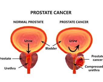 Prostate Chart with Cancer