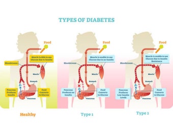 Types Of Diabetes Chart