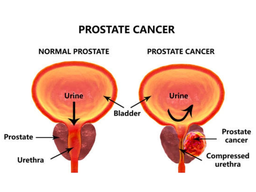 Protate Chart Prostate Chart With Cancer - Etsy