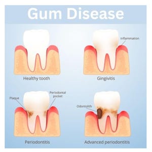 May include: Illustration showing the progression of gum disease. The first image shows a healthy tooth with pink gums. The second image shows gingivitis, with red, inflamed gums. The third image shows periodontitis, with a periodontal pocket and plaque. The fourth image shows advanced periodontitis, with a large amount of plaque and an odontolith.