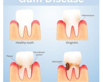 Gum Disease Gingivitis Oral disease GUM Health, oral health,