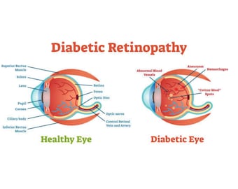 Diabetic Retinopathy Eye Chart