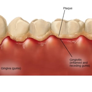May include: A close-up illustration of teeth with plaque buildup and receding gums. The caption reads "Plaque" and "Gingivitis (inflamed and receding gums)" and "Gingiva (gums)".