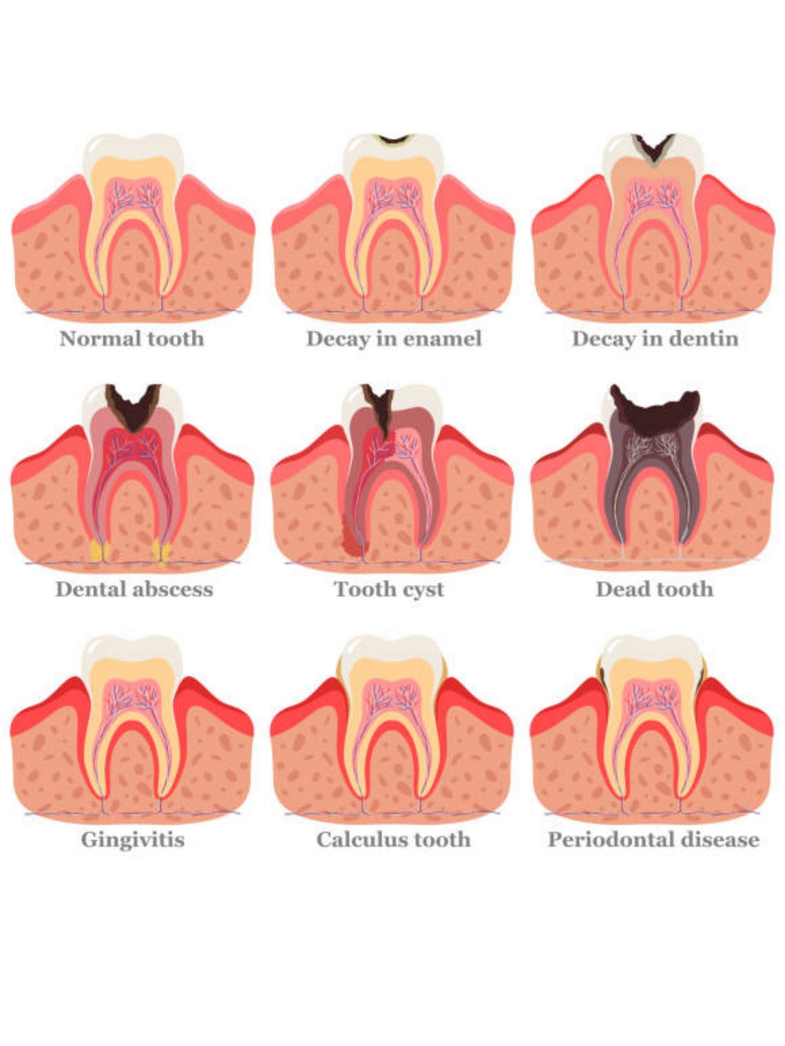 Progression of Tooth Decay Chart Etsy Australia