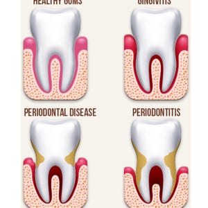 May include: Illustration showing the progression of gum disease. The first image shows healthy gums, the second shows gingivitis, the third shows periodontal disease, and the fourth shows periodontitis.