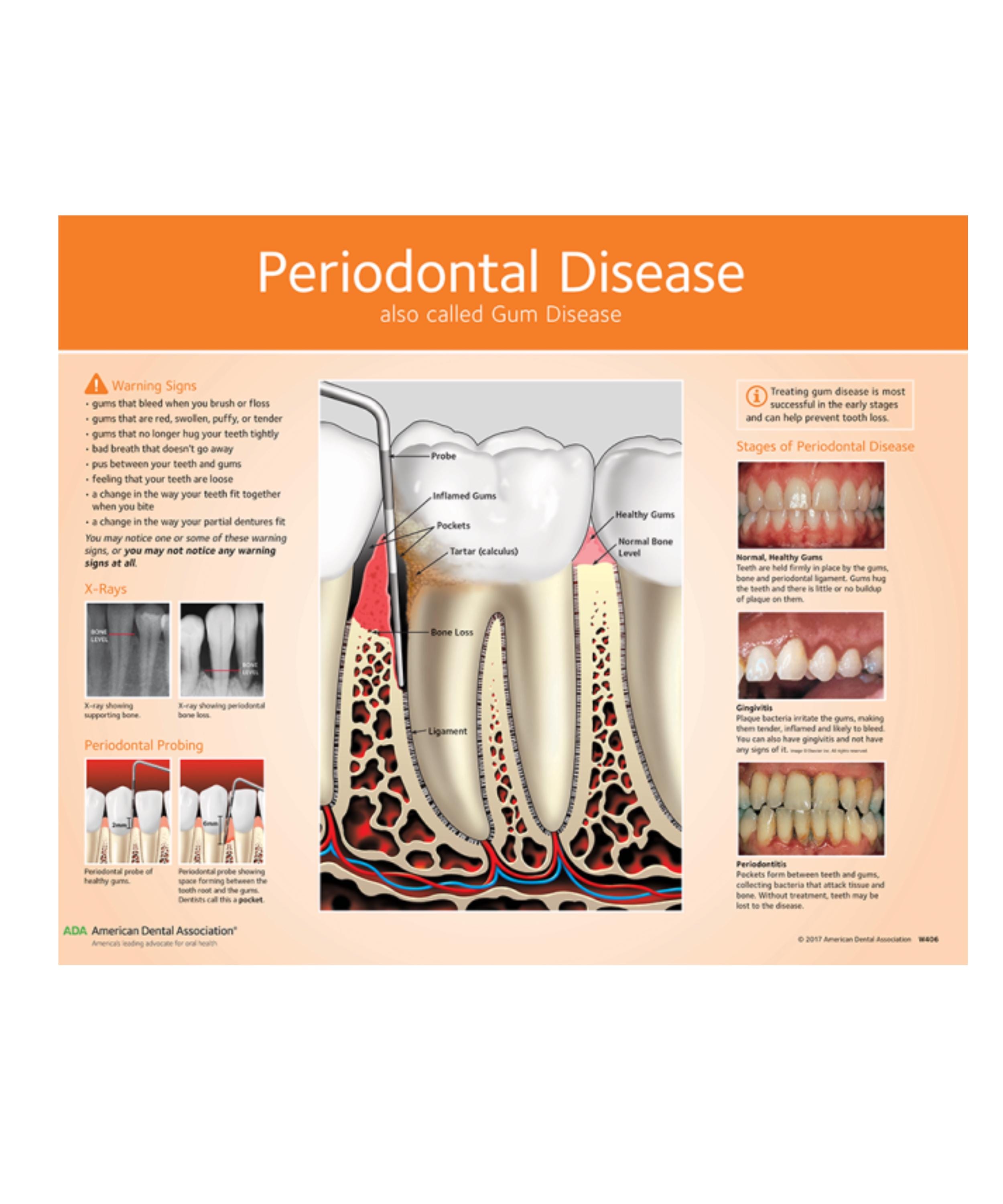 Periodontal Disease Chart, Oral Health Gingivitis Gum Disease Etsy