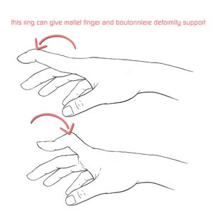 May include: Line drawing of two hands demonstrating how a ring can help support mallet finger and boutonniere deformity. The ring is not shown in the image.