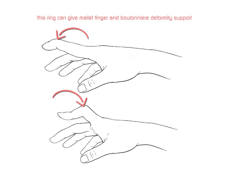 May include: Line drawing of two hands demonstrating how a ring can help support mallet finger and boutonniere deformity. The ring is not shown in the image.