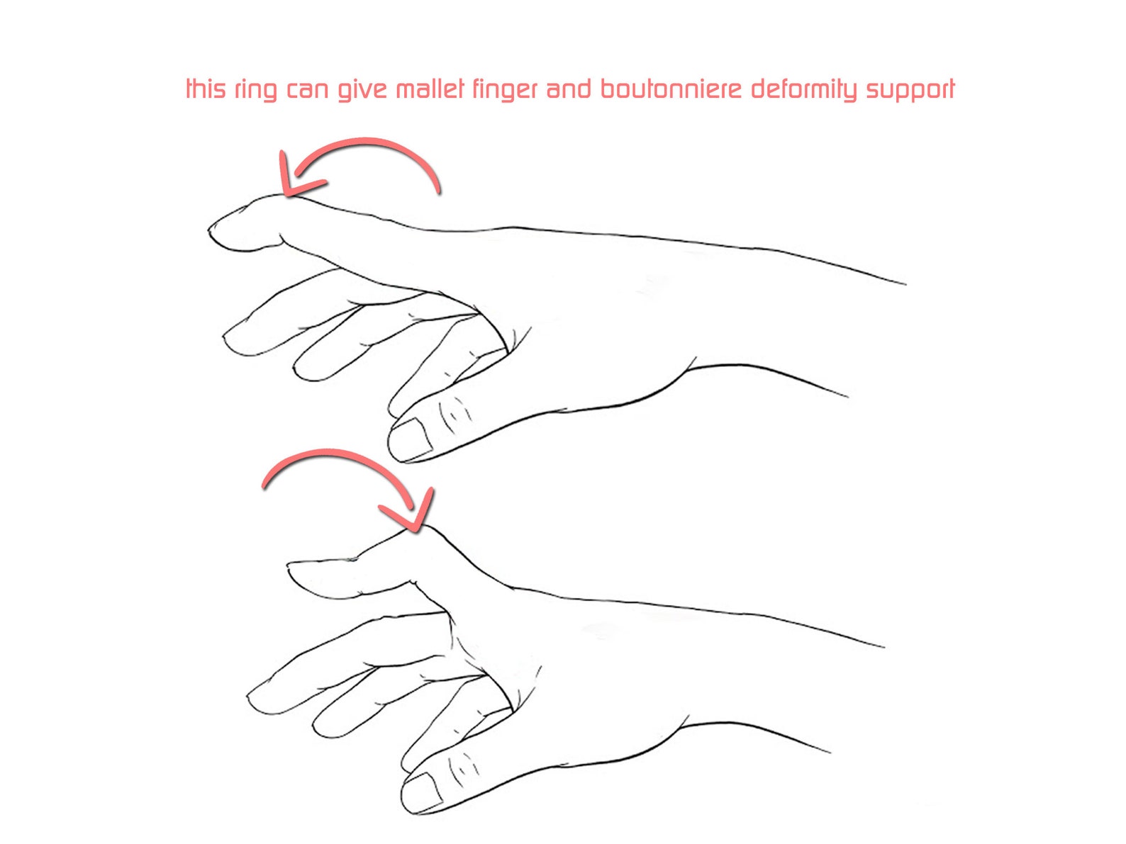 Mallet Finger Splint Boutonniere Deformity Ring Arthritis Etsy