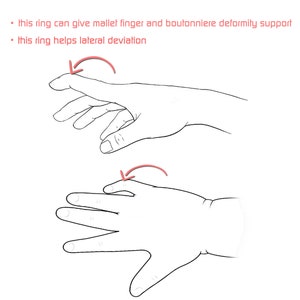 Op de afbeelding: Twee lijntekeningen van handen die laten zien hoe een ring kan helpen bij het ondersteunen van hamervinger en knoopsgatdeformiteit, evenals laterale afwijking.
